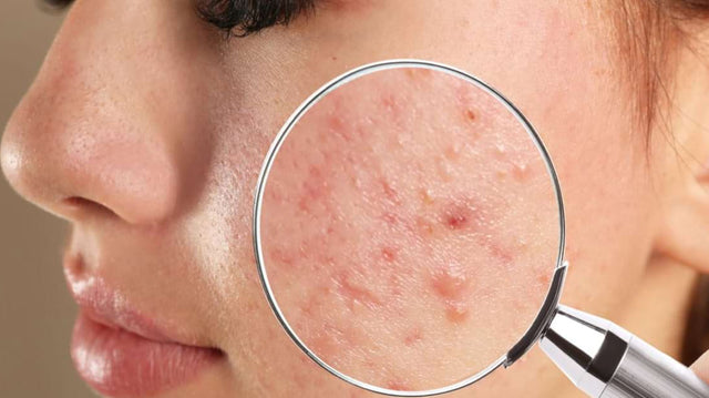 Pielea cu Acnee: Cum Să Alegi Produsele de Îngrijire Potrivite-image