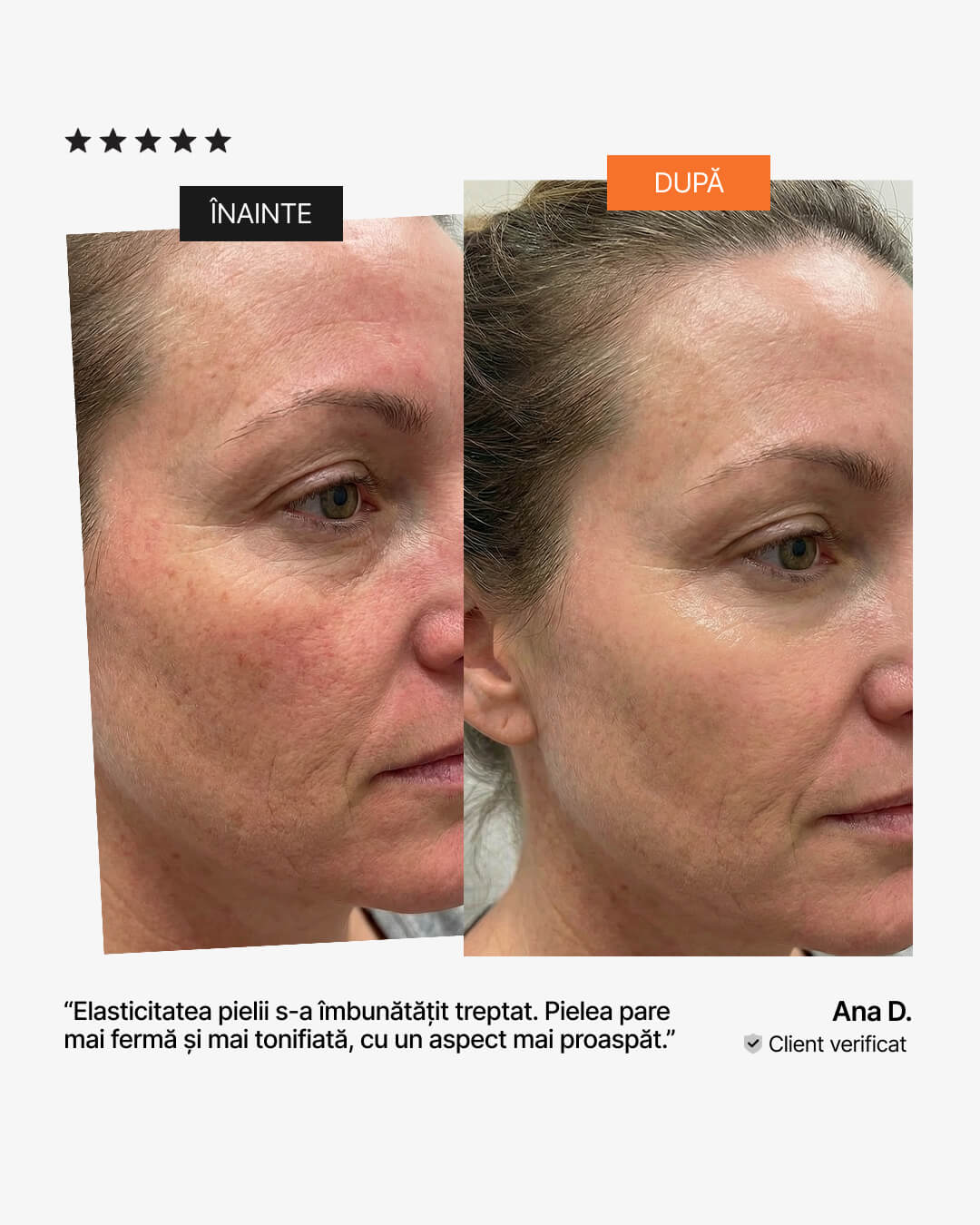 Colagen pentru elasticitatea pielii – înainte și după: ten mai ferm și mai tonifiat, recenzie 21Collagen